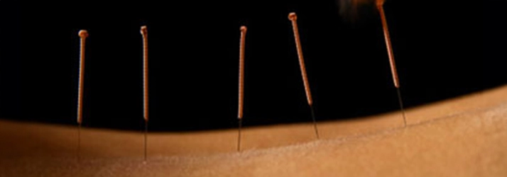 Chiropractic Greenbelt MD Dry Needling On Back